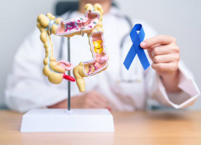 Cancer colorectal