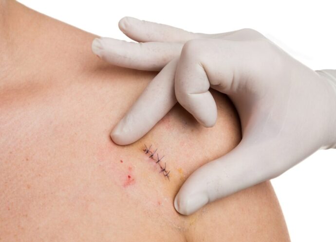 Doctor,Hands,Checking,Stitches,After,Mold,Removal,Surgery,On,Woman