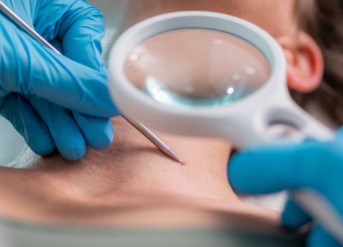 traitement des verrue